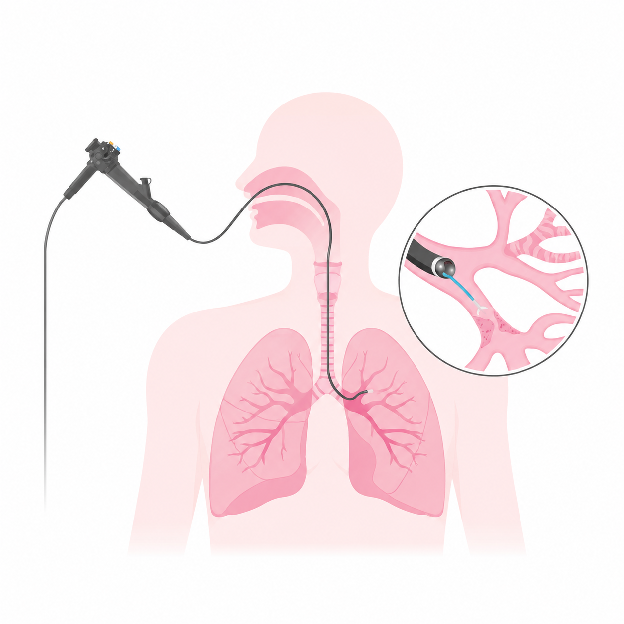 What Is Bronchoscopy