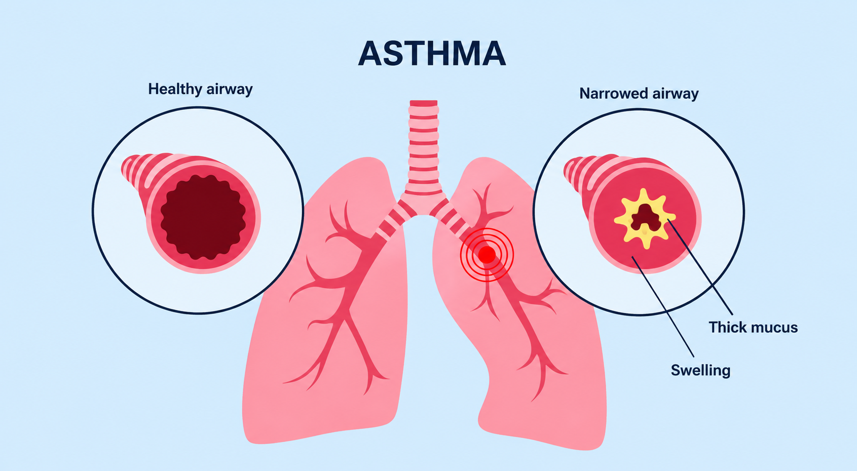 How Asthma Affects Lungs
