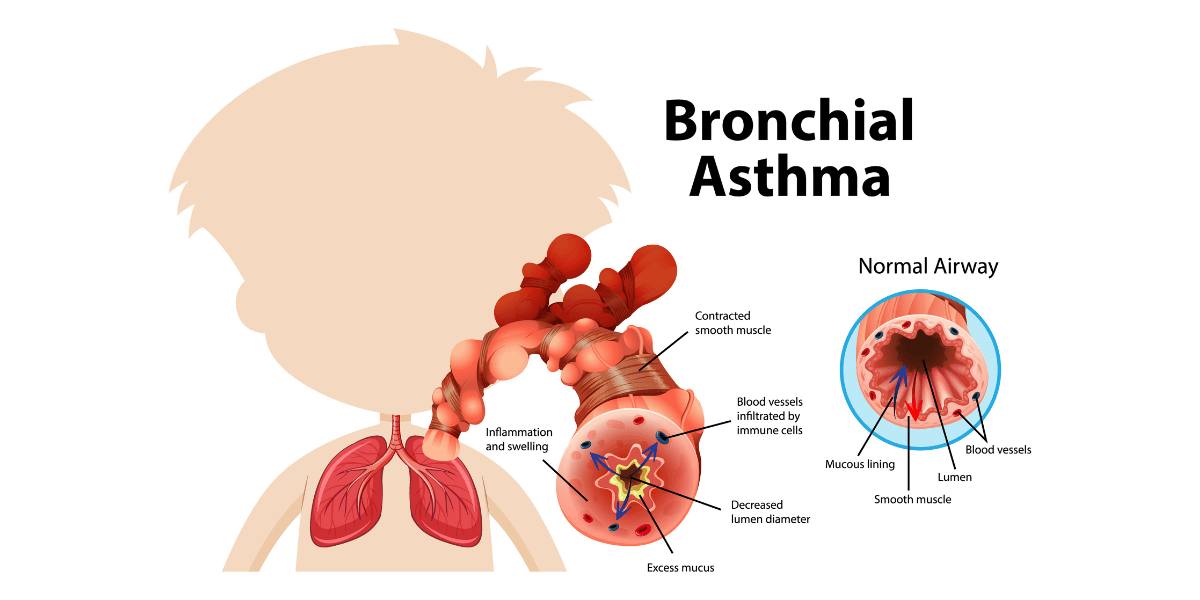 Bronchial Asthma in Mumbai